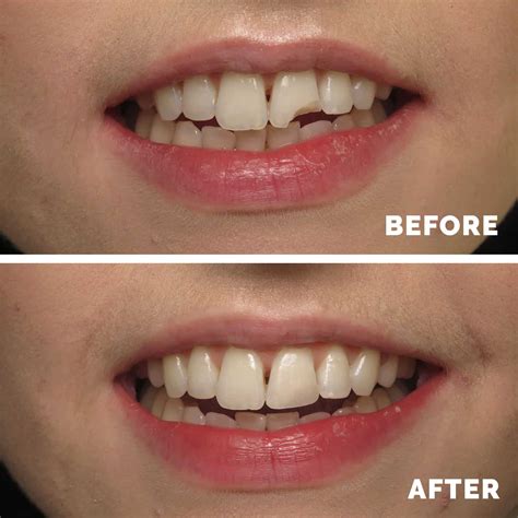 Cosmetic Bonding Chatham | Teeth Bonding | Dental Bonding Medway