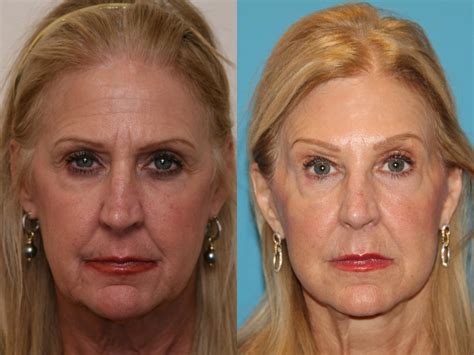 Facial Rejuvenation Before and After Pictures Case 45 | Atlanta, Georgia | Buckhead Facial ...