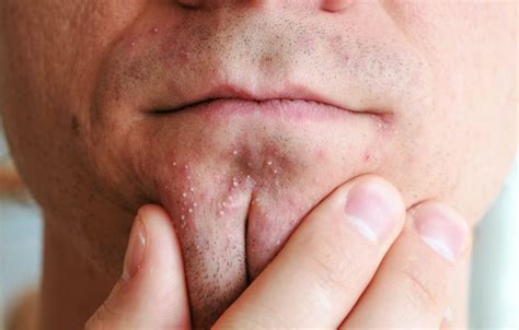 How to Treat Different Types of Acne | The Healthy