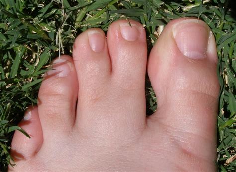 Webbed Toes: Causes, symptoms, and treatment in Dallas, Plano & Texas : u/Markthejackson