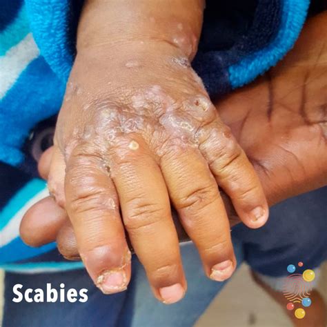 Scabies Rash On Hands