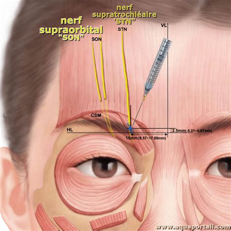 Supraorbital : définition et explications