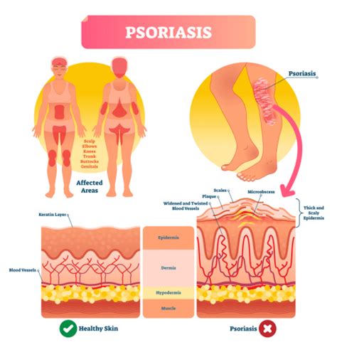 Plaque Psoriasis - Eczema-Free-Skin