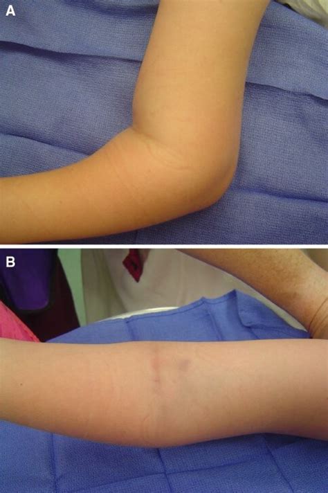 Clinical appearance of a Type III supracondylar fracture. (a) The ...