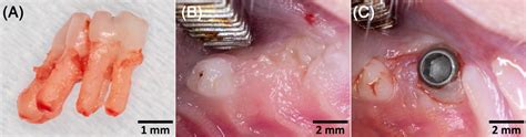 Clinical photographs. (A) Extracted maxillary first molar. (B)... | Download Scientific Diagram