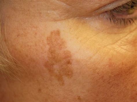 Liver Spots On Black Skin