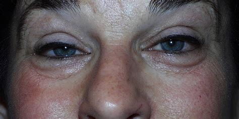 What Is Ptosis? - American Academy of Ophthalmology