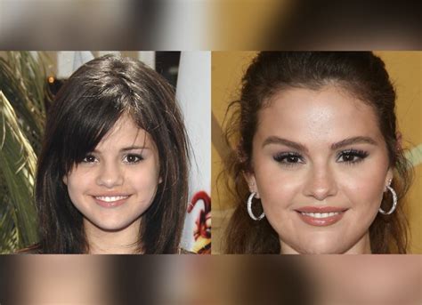 Selena Gomez Plastic Surgery: Has The Singer Undergone A Plastic Surgery?