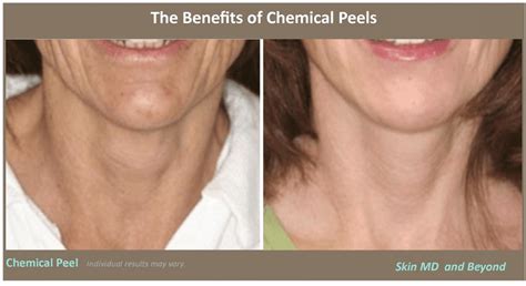 Lactic Acid Peels Before And After | Dailybonniecombs