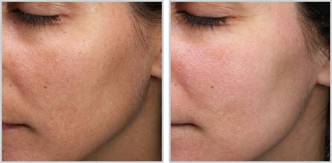 Moxi Laser Treatment Williamsport PA | BNG Aesthetics Skin & Laser Center