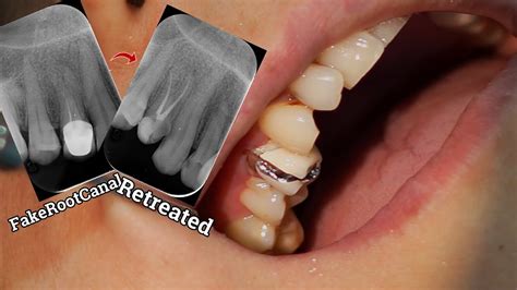 Root Canal Treatment of The Maxillary First Premolar Tooth | A Case of Retreatment. - YouTube