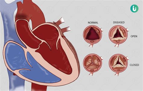 रुमेटॉइड हृदय रोग : लक्षणे, कारणे, उपचार, औषध, अटकाव, निदान - Rheumatic ...