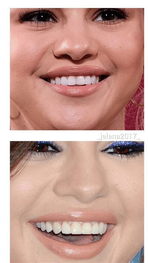 Selena Gomez Teeth Fix