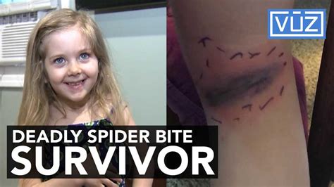 Girl hospitalized after black widow spider bite