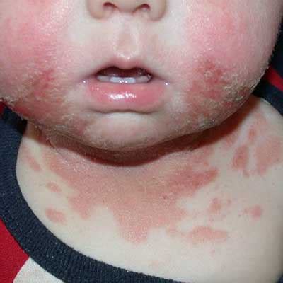 Baby Rash On Face Allergy