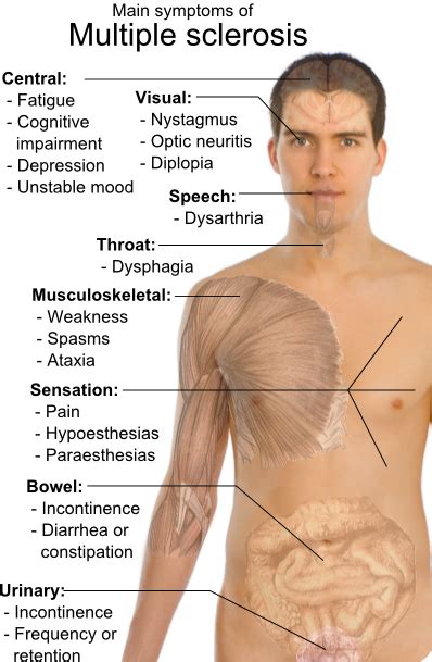 Multiple Sclerosis Symptoms And Causes >>> Health-Zine.Info