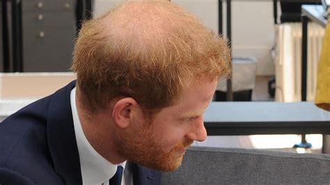 Royal hair: Prince Harry seeks help from clinic as he starts to go bald | news.com.au ...