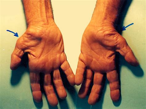 File:Untreated Carpal Tunnel Syndrome.JPG - Wikipedia, the free encyclopedia