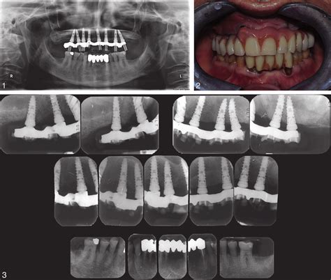 Orthopantomogram of the patient immediately after the implant placement... | Download Scientific ...