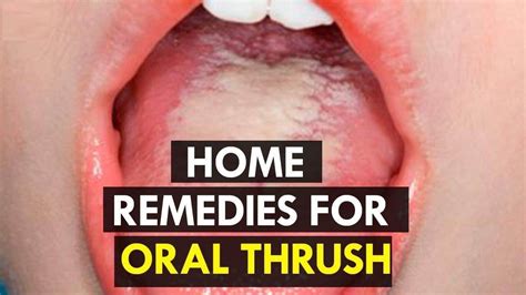 How to Treat Candida at Home | 5 Home Remedies for Oral Thrush. - YouTube