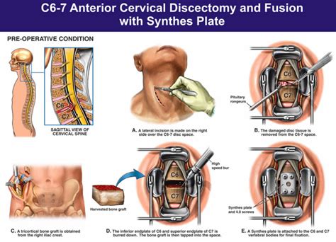 Cervical radiculopathy causes, symptoms, diagnosis & treatment