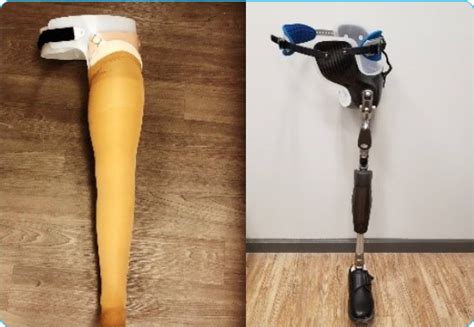 Hip Disarticulation or Hemipelvectomy Amputee – Comprehensive Prosthetics & Orthotics