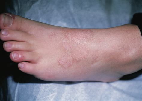 Hiv Rash On Feet