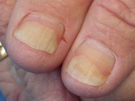 Toenail Problems: Causes, Symptoms, and Treatments