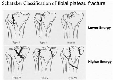 Tibial plateau fracture causes, types, symptoms, diagnosis & treatment