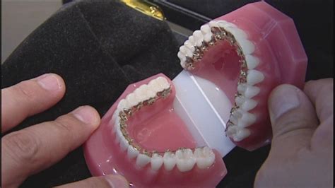 Invisible braces are growing trend for adults | abc13.com