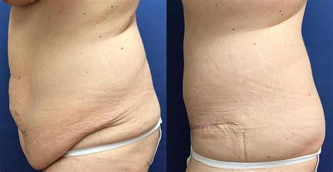 Panniculectomy Before & After Patient 297 HD wallpaper | Pxfuel