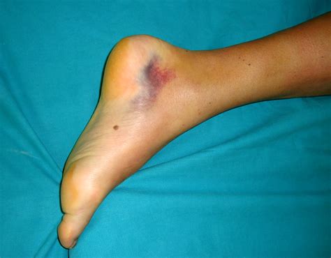 Achilles Tendon Rupture Surgery | Achilles tendonitis, Achilles tendon ruptures, Achilles