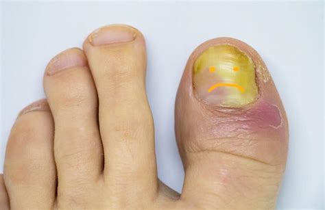 Get Rid of That Toenail Fungus Before Summer: California Foot and Ankle Clinic: Podiatrists