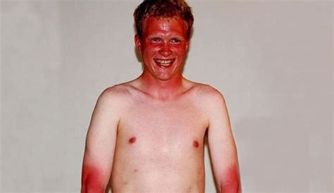 OC Man Suffers Incredibly Severe Sunburn After Waiting 6 Hours for ...