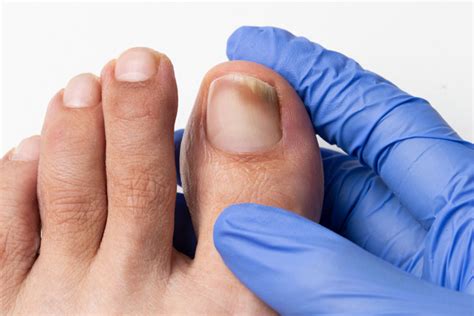 Toenail Fungus Treatment – What are my options? — FOOT & ANKLE CENTERS