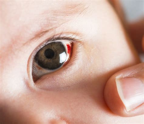 Subconjunctival Hemorrhage Newborn