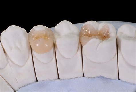 Inlays and Onlays Collingwood | Collingwood Family Dental