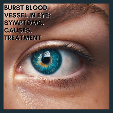Burst Blood Vessel in Eye: Symptoms, Causes, Treatment - YouMeMindBody