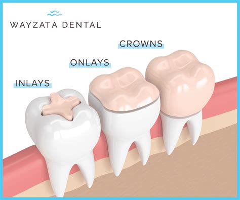 Dental Inlays Vs. Onlays: Do You Need Them? (Pros & Cons)
