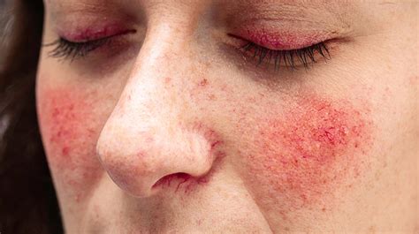 Causes of rosacea: Treatments, types, and symptoms