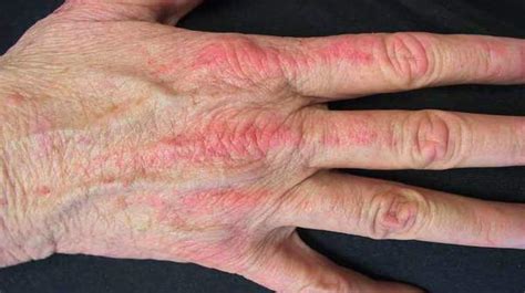 Dermatomyositis: Causes, Symptoms, & Treatment