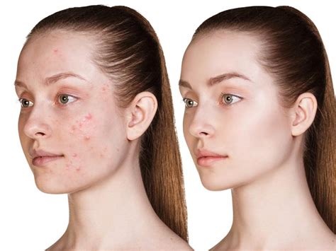 Acne Treatment Simple
