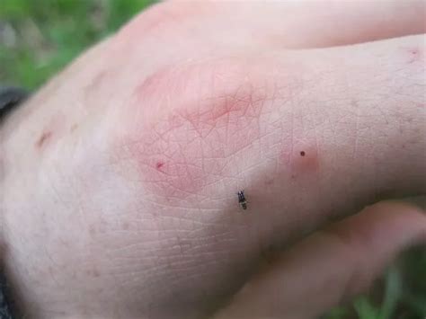 The simple trick that helps cure insect bites - Manchester Evening News