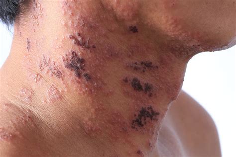 What Does Painful Shingles Look Like? - sage-quotes