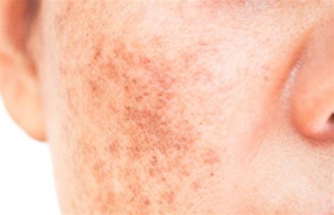 Sun spots vs Freckles : What's The Difference? - the daily glimmer