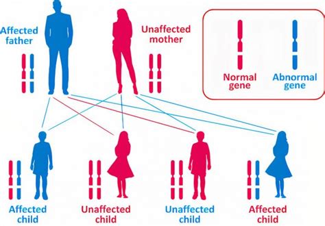 Achondroplasia | Causes, Signs, Standard Therapies, Prevention in ...