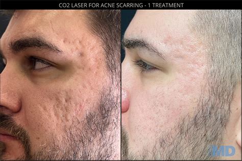 CO2RE® Laser Resurfacing | Boston - Skin MD