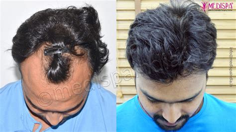 Hair Transplant Before and After - Mumbai, India