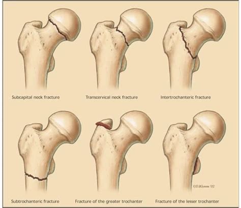 Pin on Medical | Hip fracture, Orthopedics, Medical anatomy