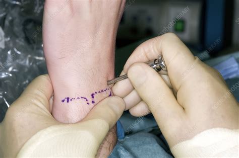 Arthroscopic wrist surgery - Stock Image - C004/5140 - Science Photo Library